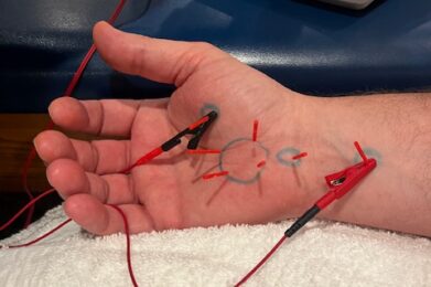 Certification in Upper Extremity & Hand Dry Needling | IDN